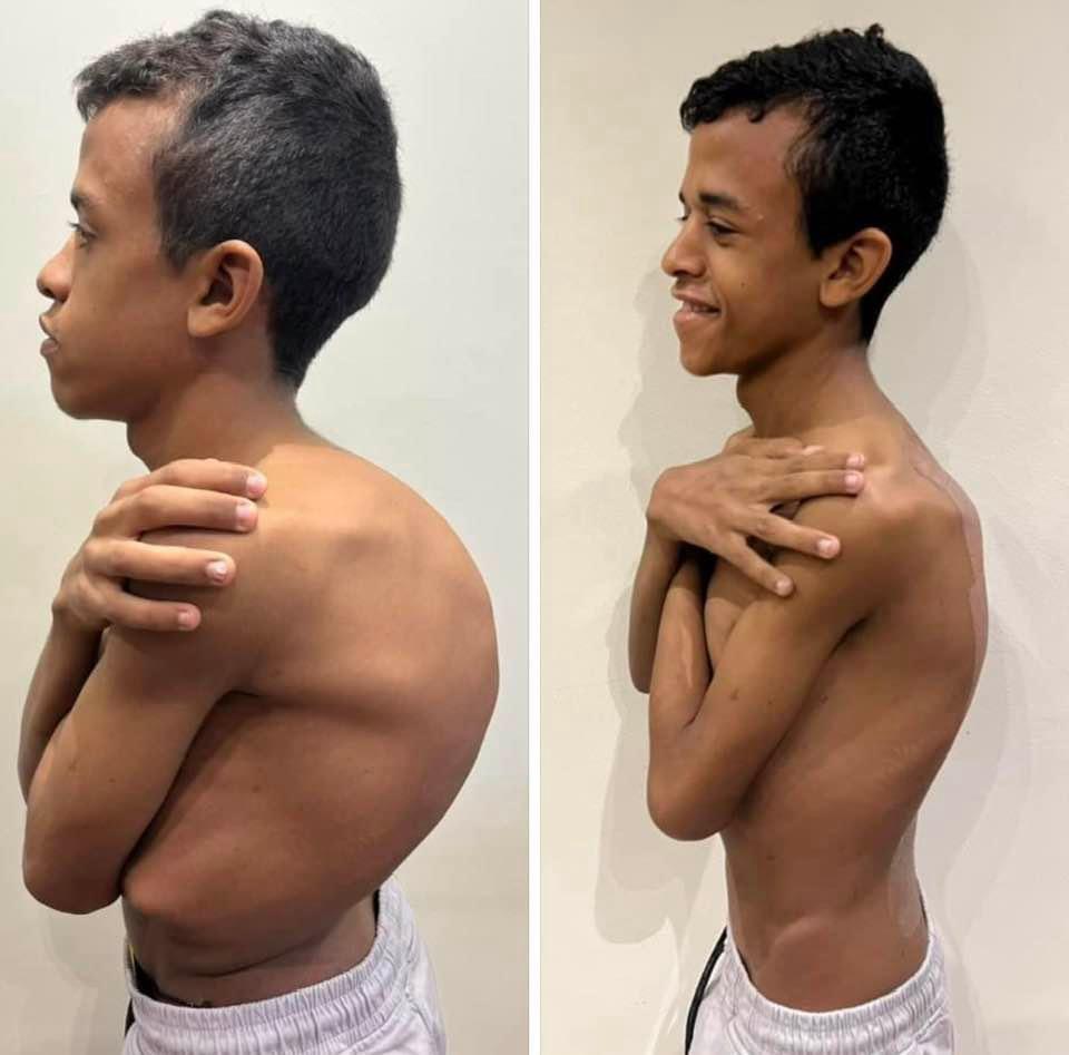 Kyphosis Correction Surgeries